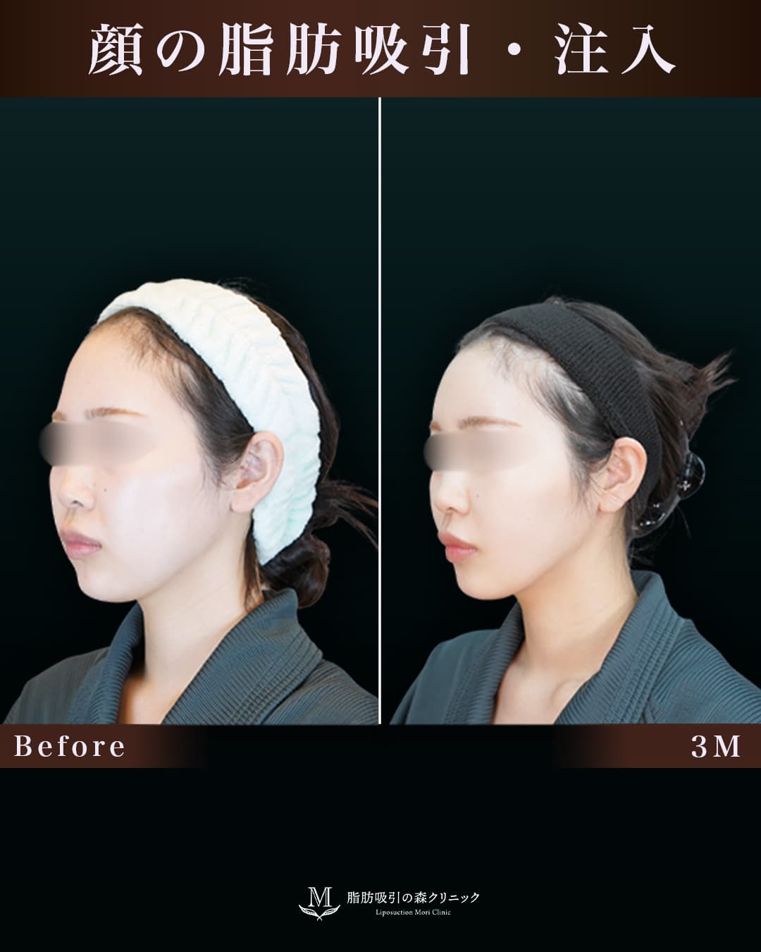 脂肪注入で自然な丸みのあるおでこに!の症例写真