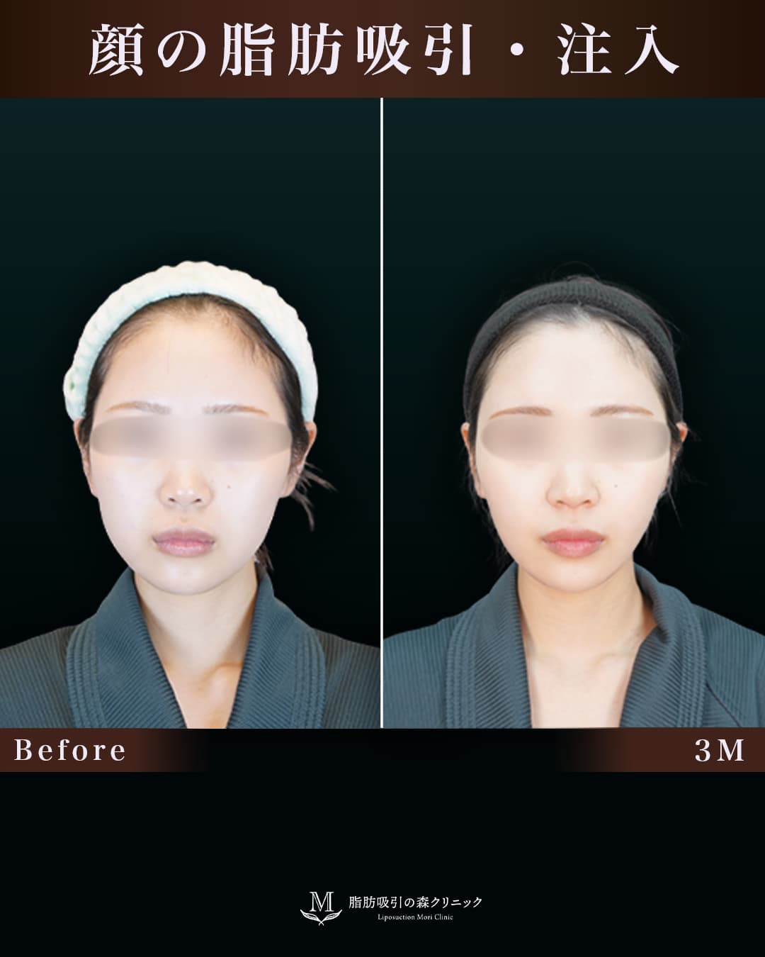 脂肪注入で自然な丸みのあるおでこに!の症例写真